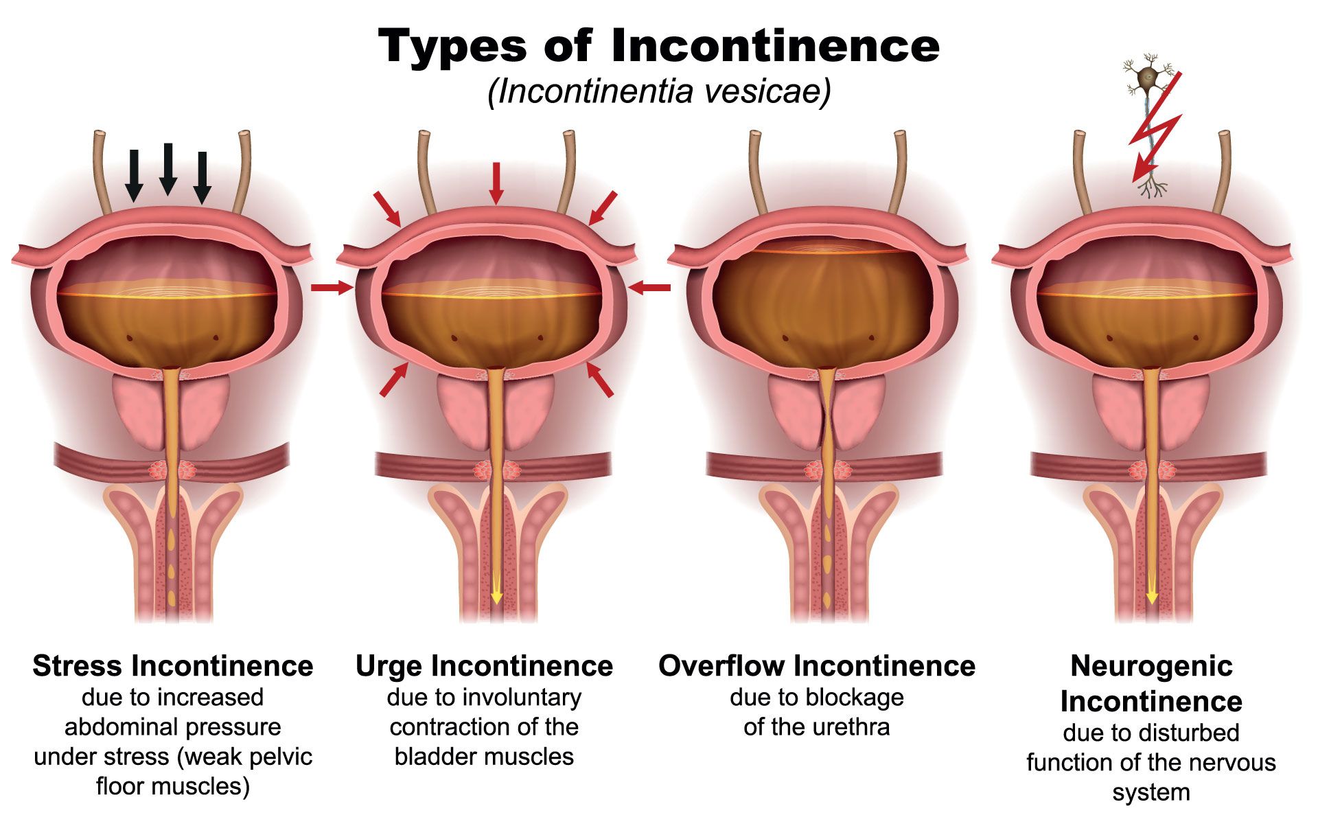types of incontinence