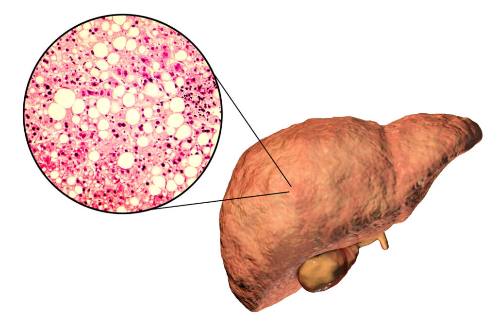 digital rendition of unhealthy liver