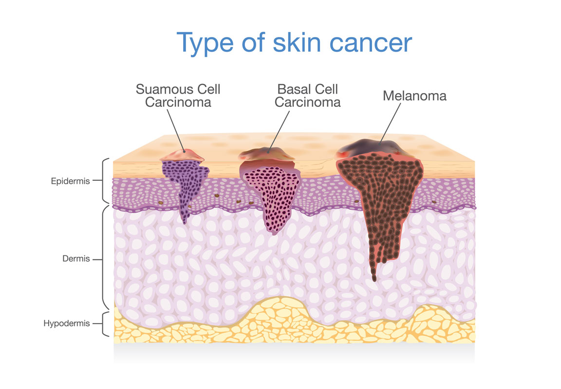 diagram depicting types of skin cancer