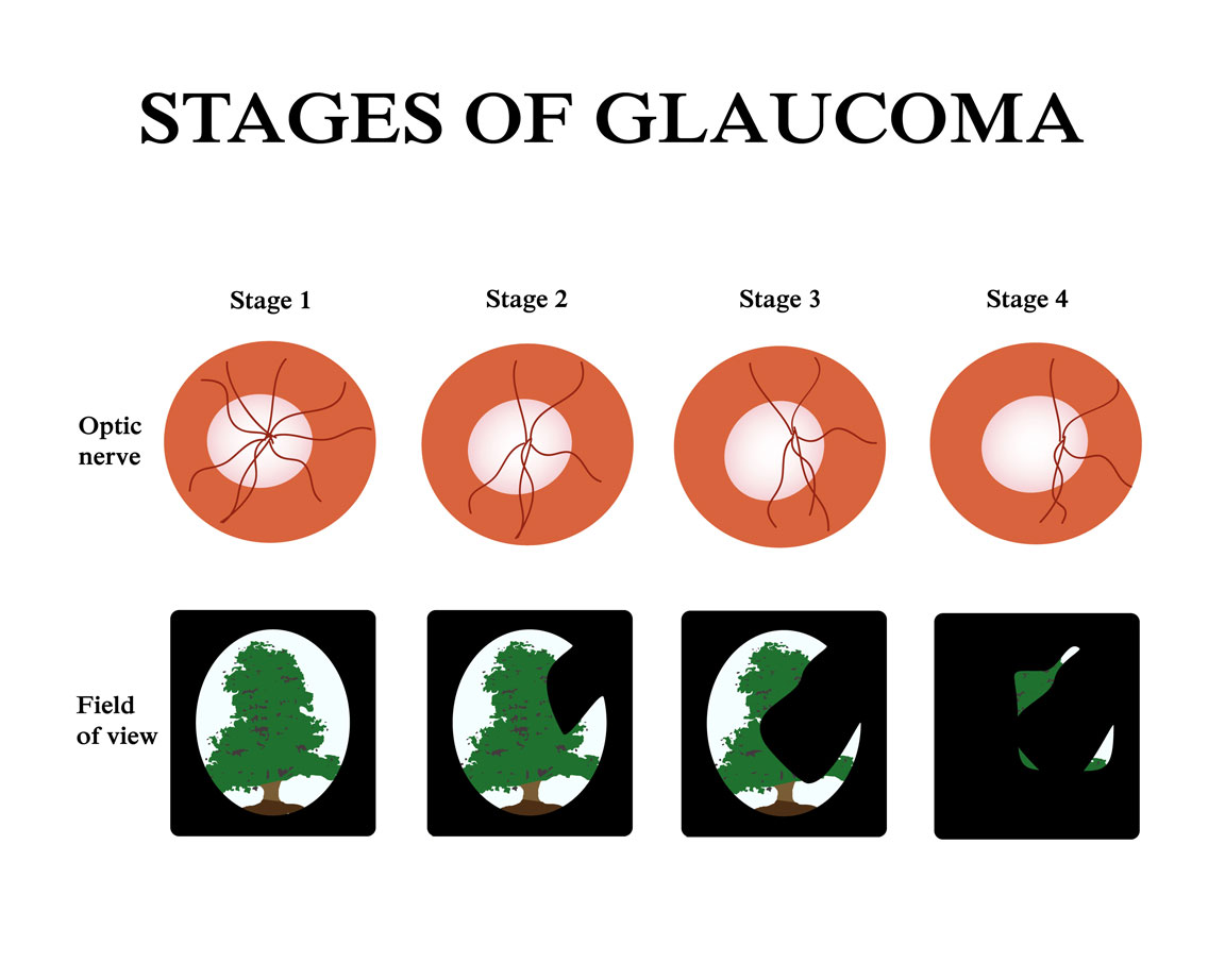 the stages of glaucoma