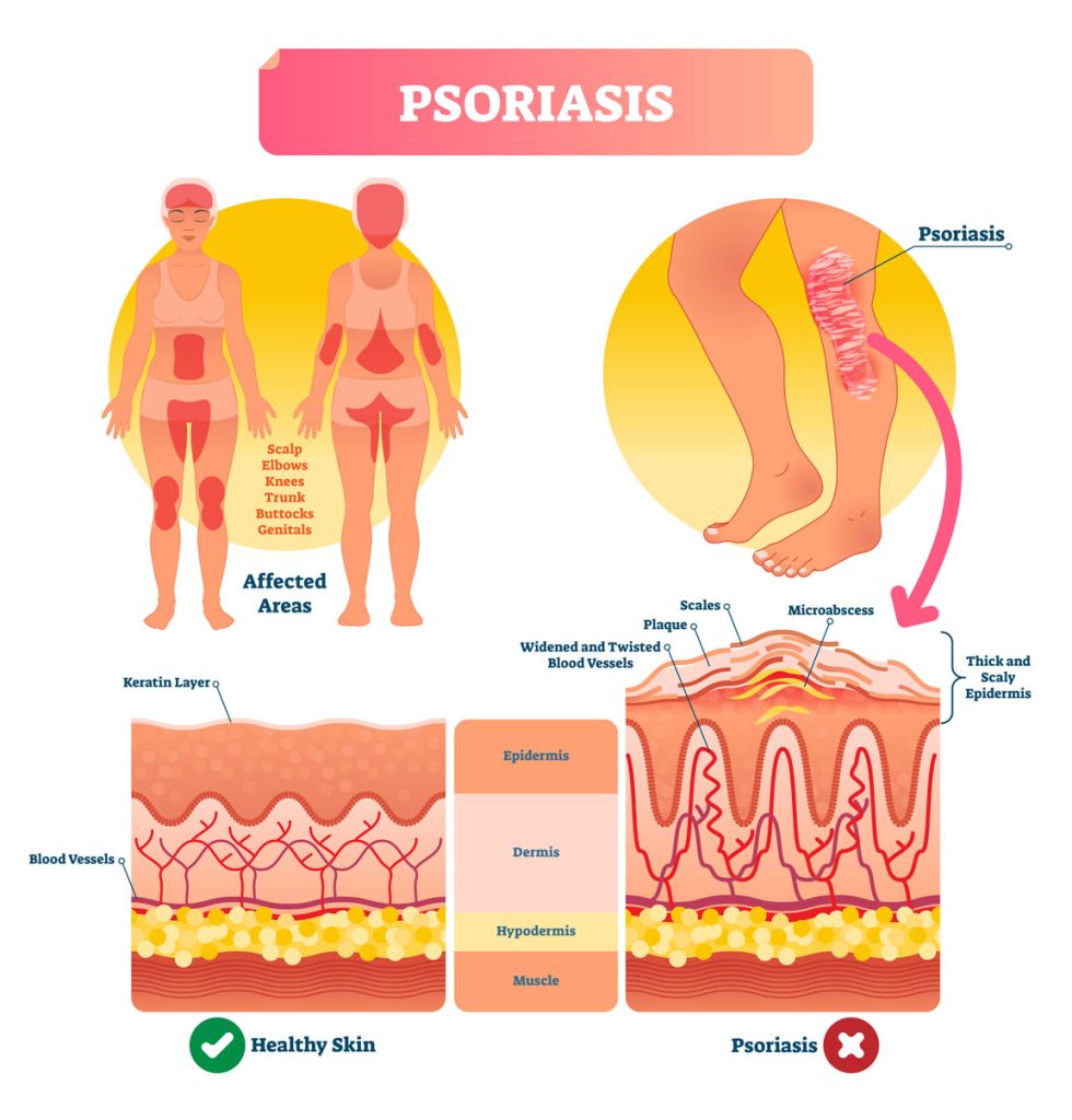 psoriasis diagram