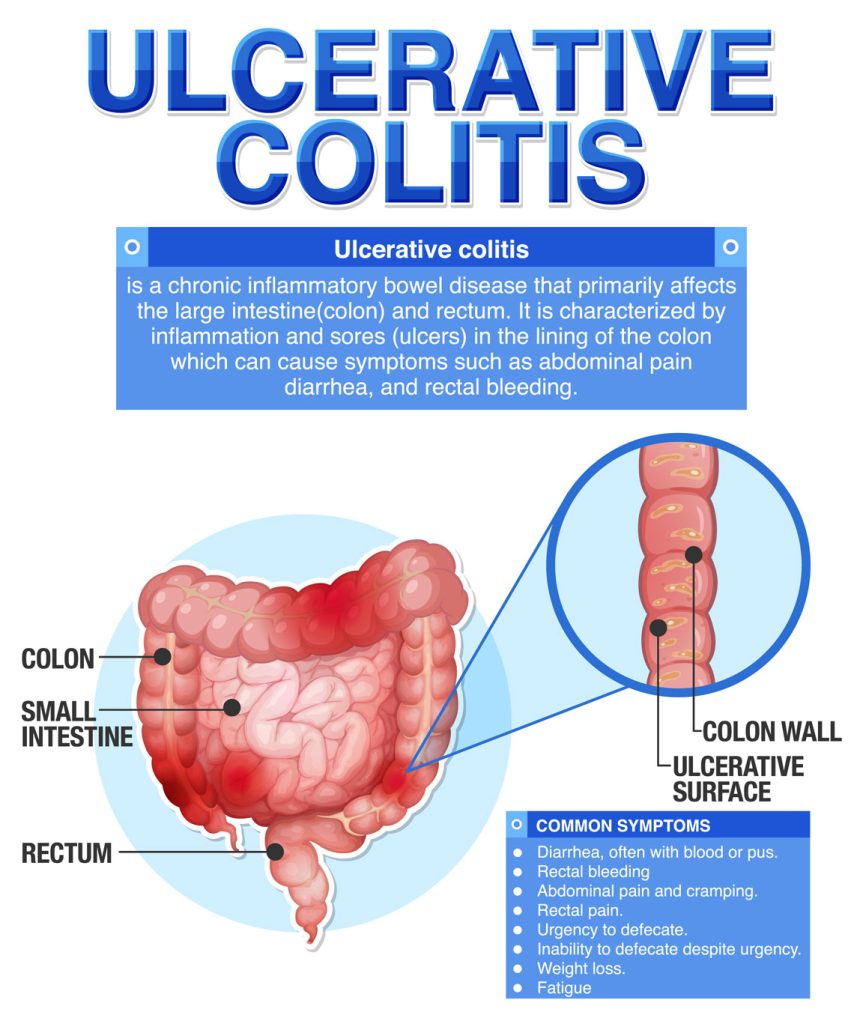 ulcerative colitis diagram